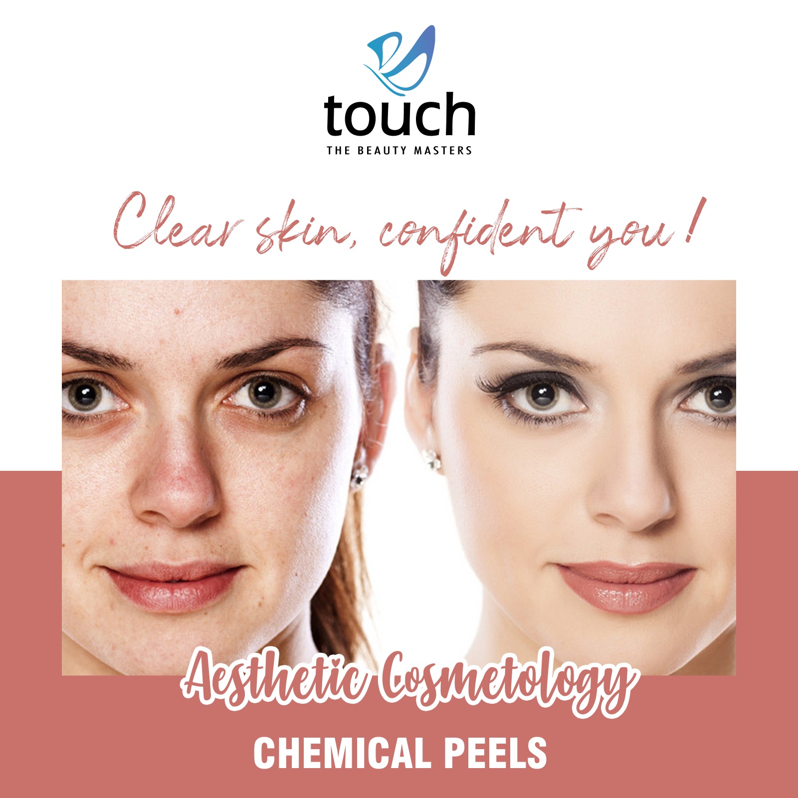 Chemical Peels