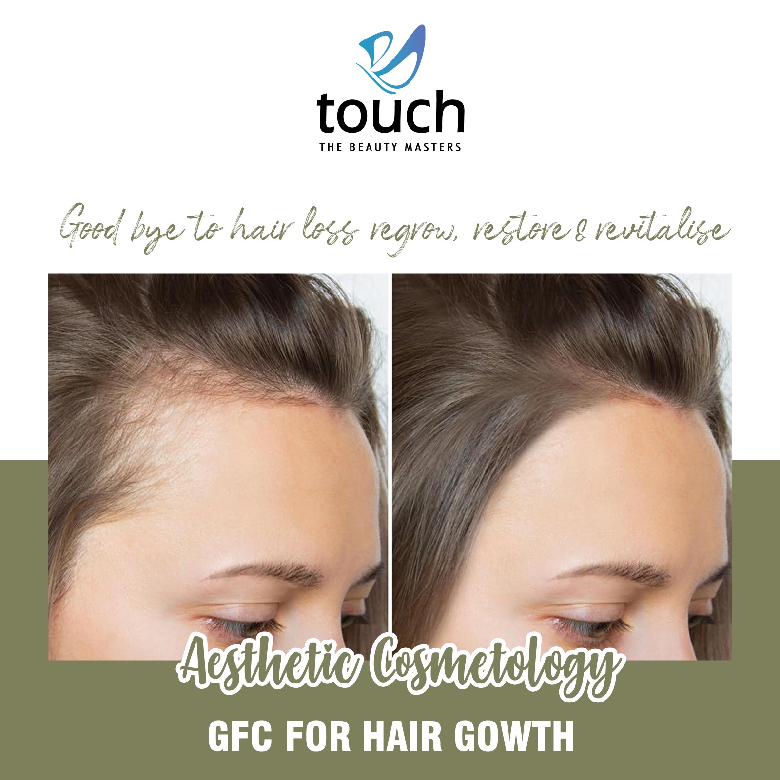 PRP-GFC for Hair Growth